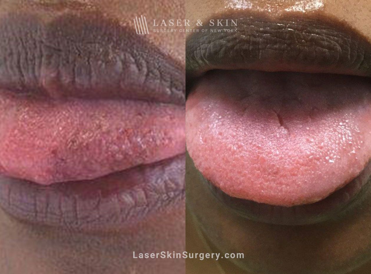 laser acne scar treatment in new york, ny