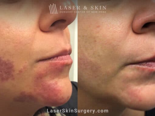 Pulsed Dye Laser to Treat Port Wine Birthmark
