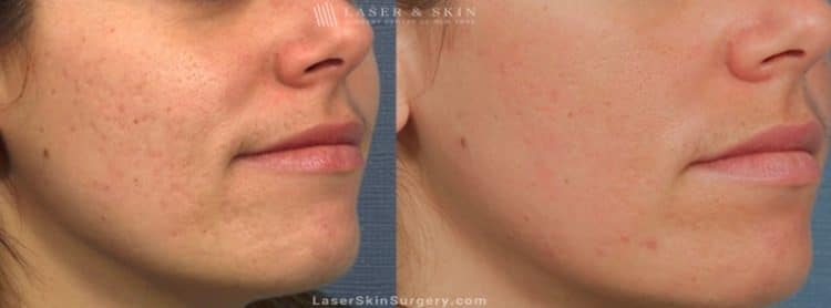 acne scarring treatments-NY-NY teenage acne scarring treatments in NY,NY