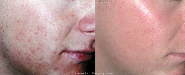teenage acne treatments-NY-NY teenage acne treatments NYC