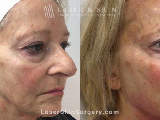 Juvederm Fillers to Rejuvenate the Face